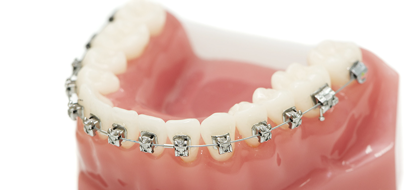 歯の表側に装着する金属製の矯正装置