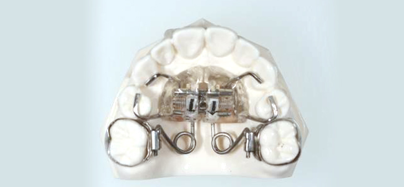 プレートを使った口蓋側に装着する固定式矯正装置